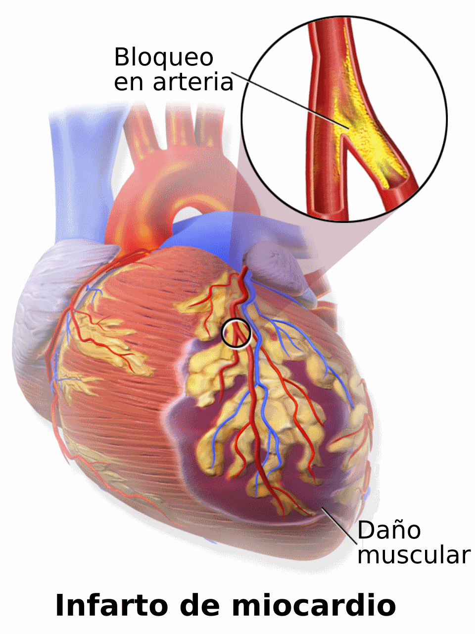 Esquema de una arteria coronaria obstruida y la zona del corazón afectada por un infarto